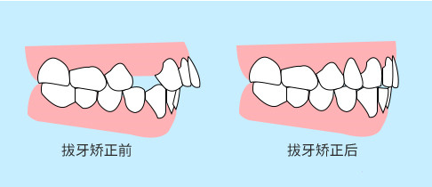 牙齒矯正前后對(duì)比圖